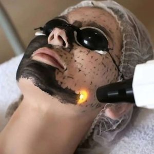 carbon laser peel