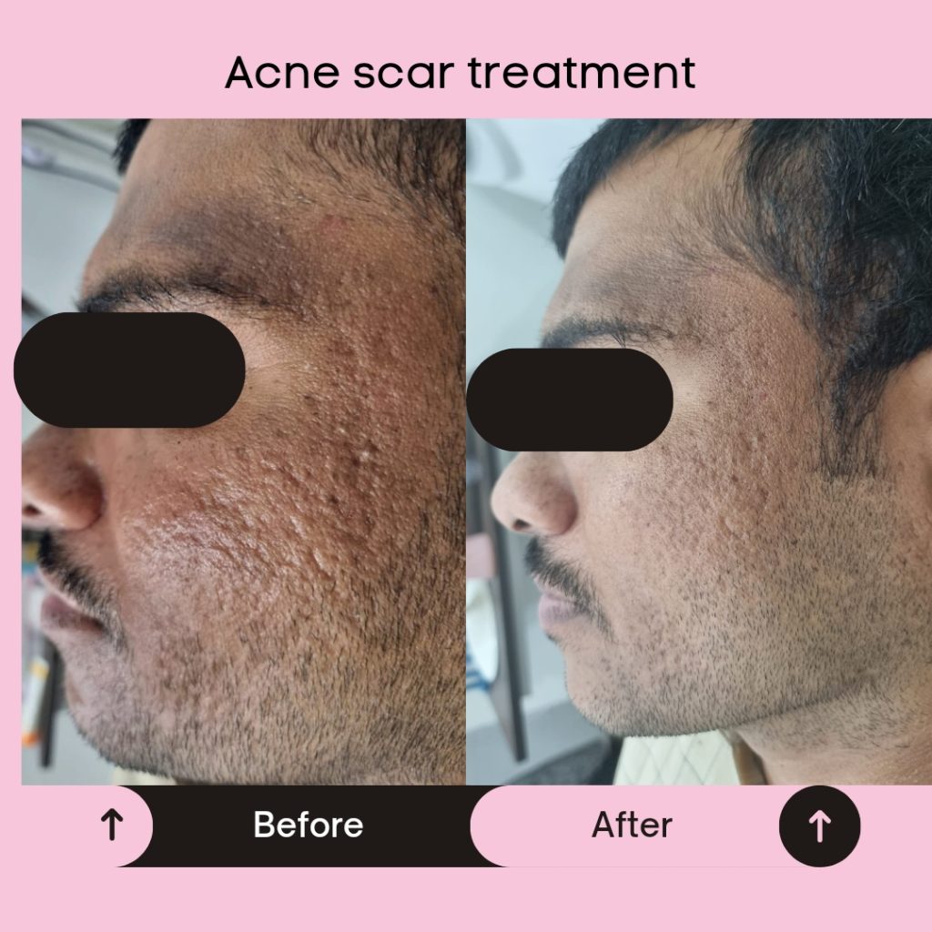 Acne scar treatment in pune