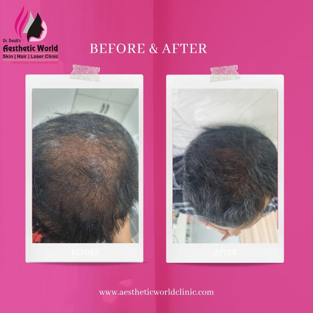 Hair GFC treatment in Pune
