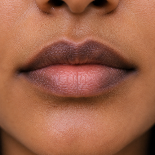 Close-up of dark and uneven lip pigmentation