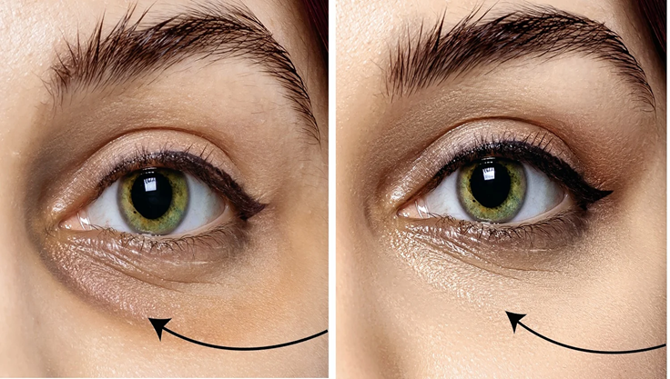 Under-eye pigmentation and dark circles