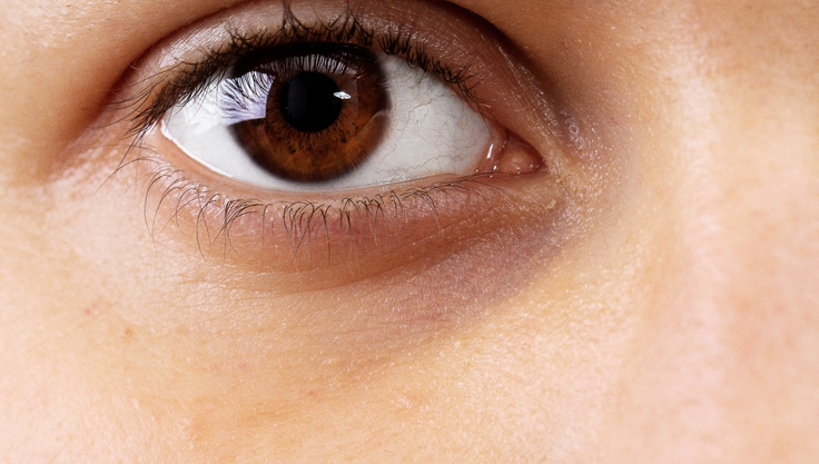 Under-eye vascular dark circles