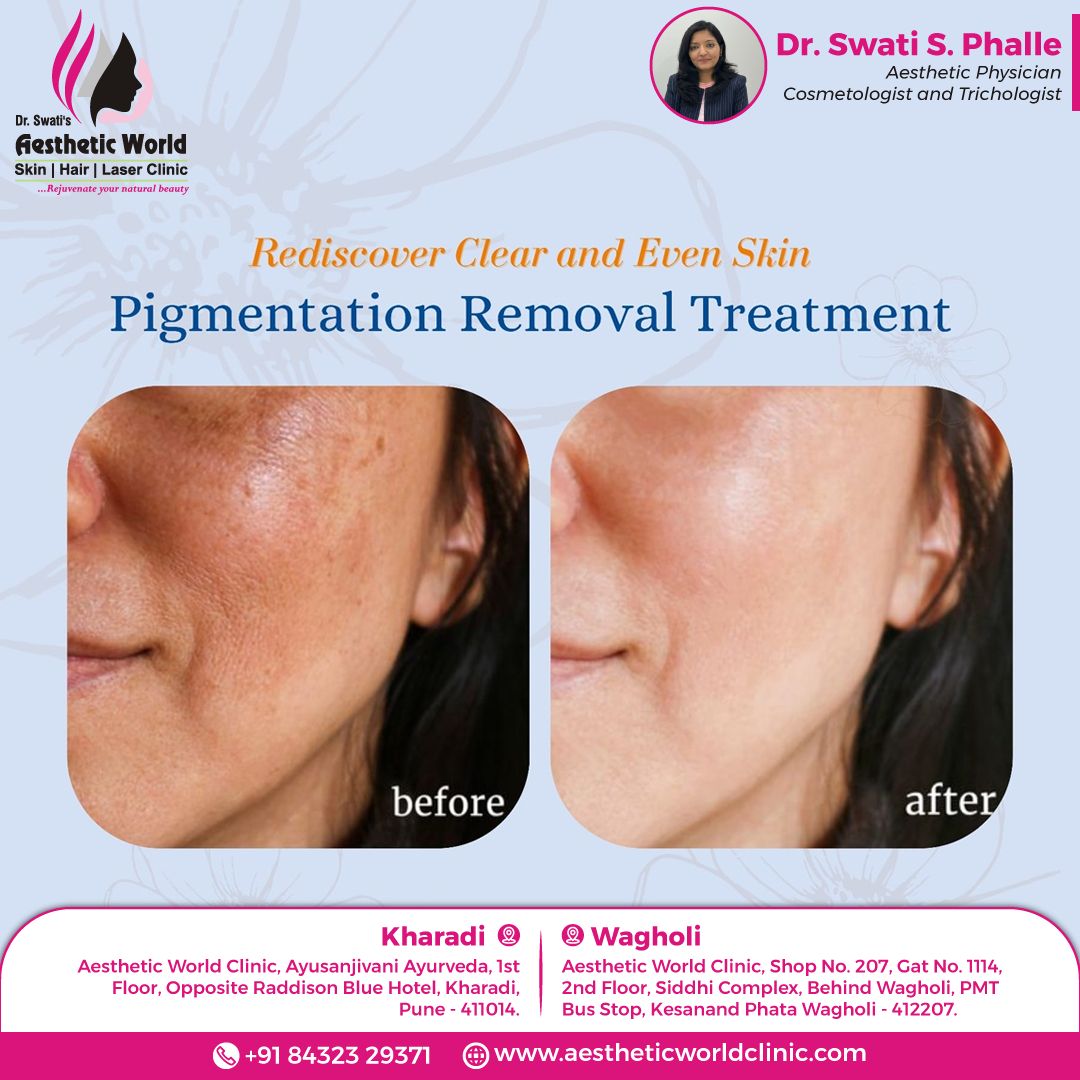 best treatment for pigmentation