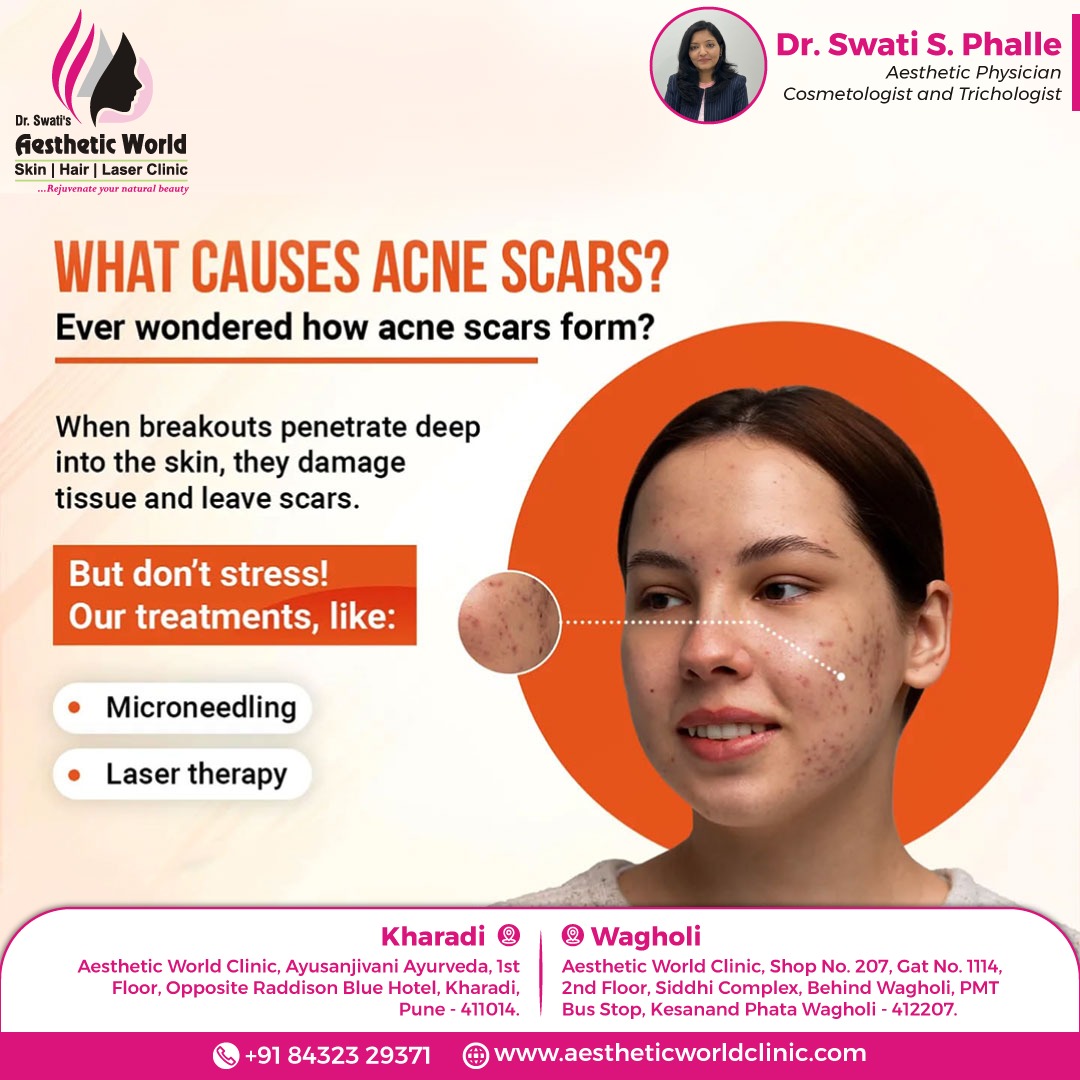 best treatment for acne scars