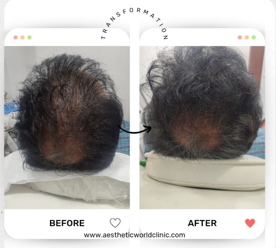 PRP hair treatment cost in Pune