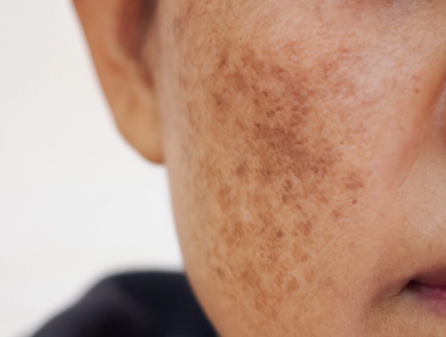 glutathione for melasma testimony Treatment in Kharadi ALL DISPO E-Cig Amazon.com: Live Wise Naturals Tablets:30 Tablets